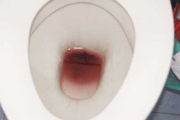 blettablæðingar hjá körlum þegar þeir eru spenntir